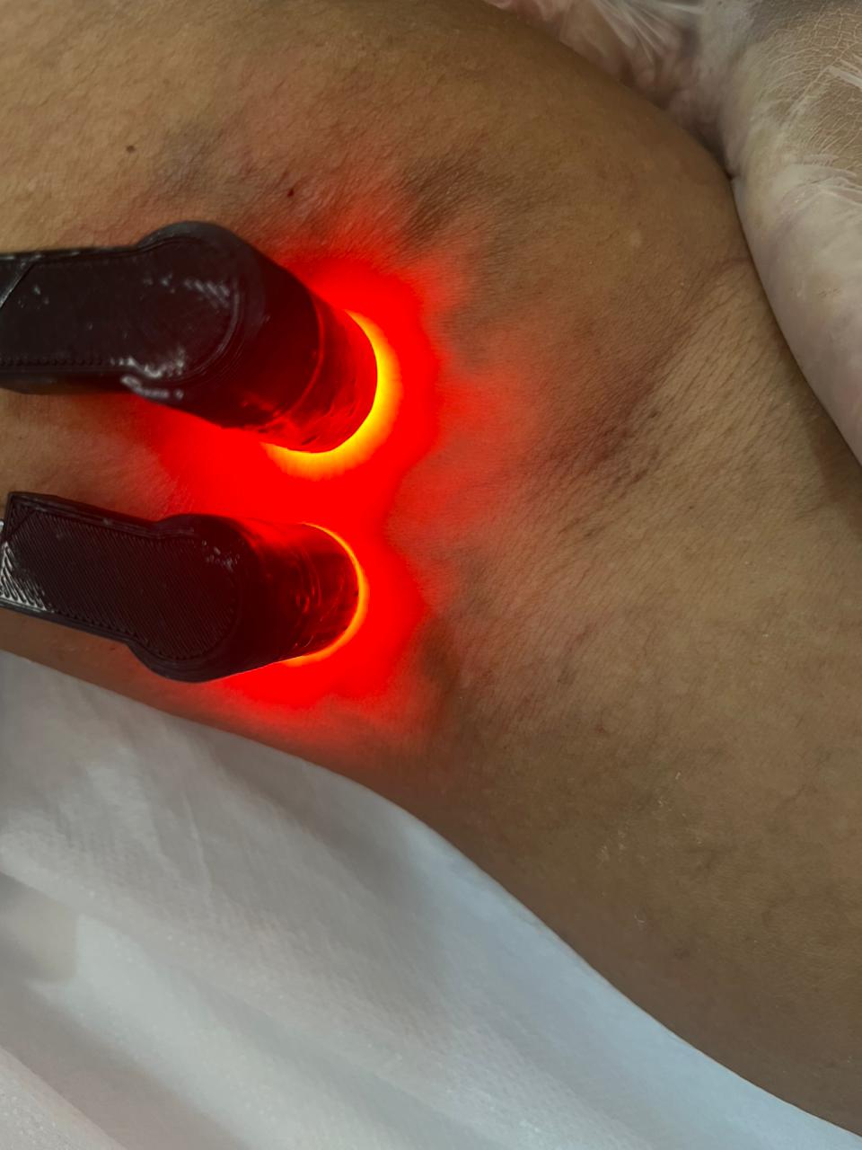 Tratamento a laser para varizes
